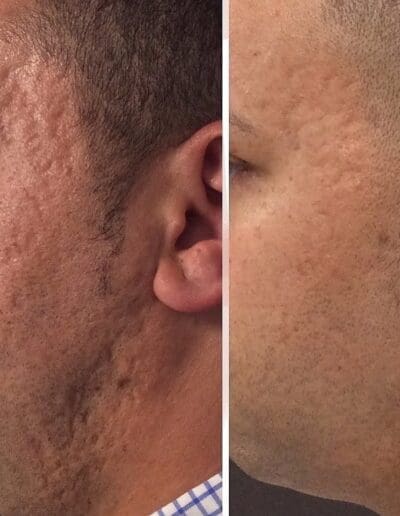 Skin Pen MicroNeedling at Daniel Shay's