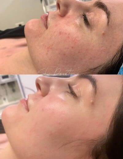 Skin Pen MicroNeedling at Daniel Shay's