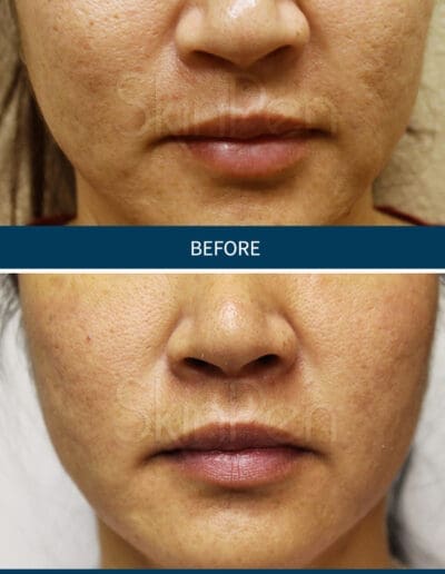 Skin Pen MicroNeedling at Daniel Shay's